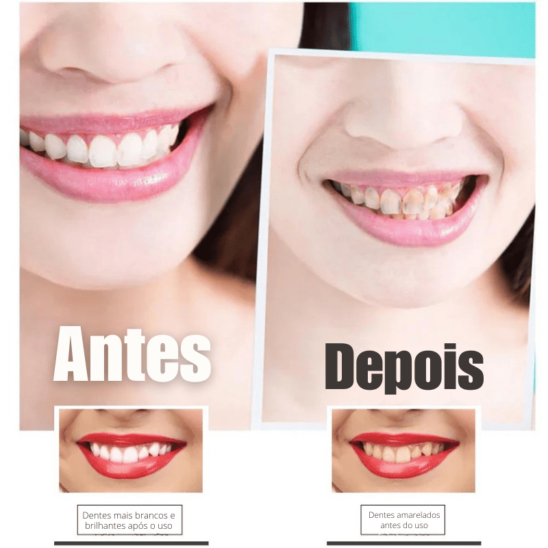 SmileKit – Clareamento total em 30 minutos Position 7
