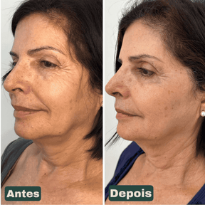 CollageSkin – Máscara Anti-idade com Efeito Lifting Position 4