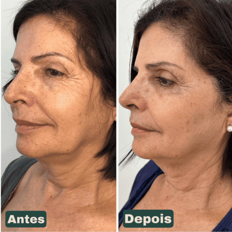 CollageSkin – Máscara Anti-idade com Efeito Lifting Position 4